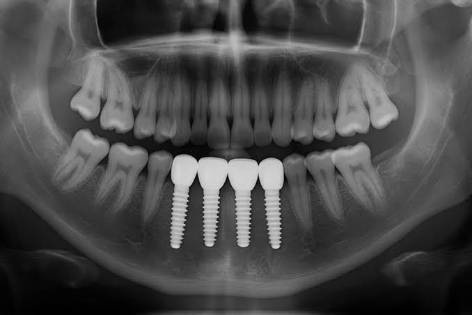 Dental implants treatment Austin TX